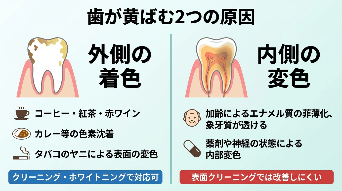 歯が黄ばむ2つの原因を対比したイラスト。左側「外側の着色」＝コーヒー・紅茶・赤ワイン・カレー等の色素沈着、タバコのヤニによる表面の変色（クリーニング・ホワイトニングで対応可）。右側「内側の変色」＝加齢によるエナメル質の菲薄化で象牙質が透ける、薬剤や神経の状態による内部変色（表面クリーニングでは改善しにくい）。歯の断面図で違いを示す