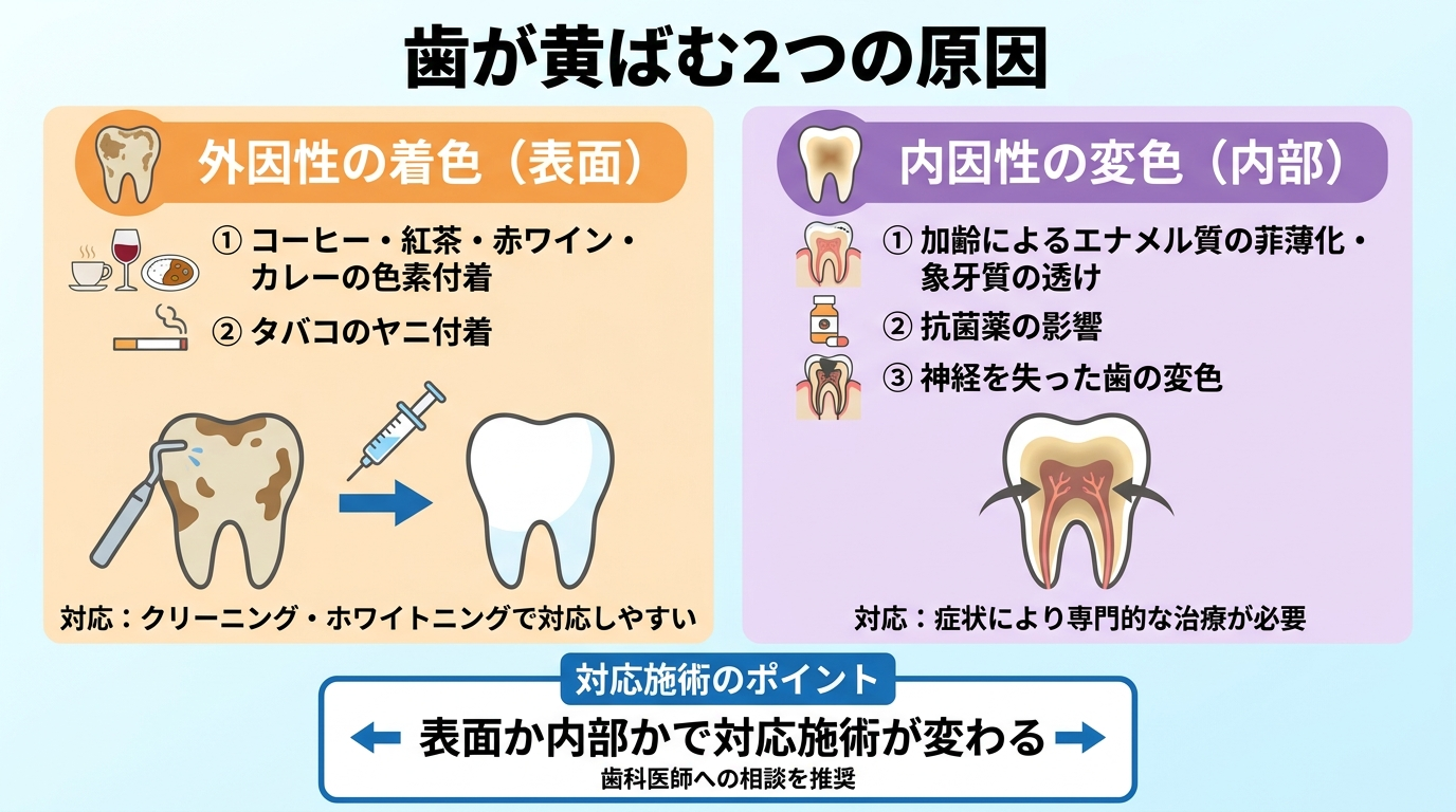 歯が黄ばむ2つの原因を対比したイラスト。左側「外因性の着色」=コーヒー・紅茶・赤ワイン・カレーの色素、タバコのヤニが歯の表面に付着(クリーニングやホワイトニングで対応しやすい)。右側「内因性の変色」=加齢によるエナメル質の菲薄化と象牙質の透け、抗菌薬の影響、神経を失った歯の変色。表面か内部かで対応する施術が変わることを示す