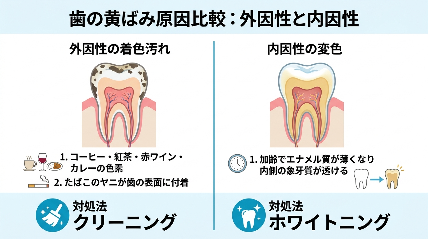 歯が黄ばむ2つの原因を比較したイラスト。左:外因性の着色汚れ(コーヒー・紅茶・赤ワイン・カレーの色素、たばこのヤニが歯の表面に付着)、右:内因性の変色(加齢でエナメル質が薄くなり内側の象牙質が透ける)。それぞれの対処法(クリーニング/ホワイトニング)も併記