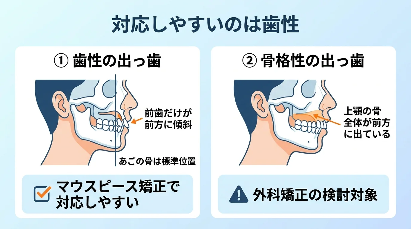 出っ歯の2タイプを比較した図解。左側「歯性の出っ歯」=あごの骨は標準位置で前歯だけが前方に傾いているイラスト、マウスピース矯正で対応しやすいと明記。右側「骨格性の出っ歯」=上顎の骨全体が前方に出ているイラスト、外科矯正の検討対象と明記。中央に「対応しやすいのは歯性」の見出し