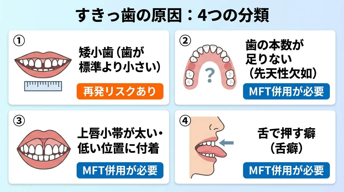すきっ歯の4つの原因を分類したインフォグラフィック。①矮小歯（歯が標準より小さい）②歯の本数が足りない（先天性欠如）③上唇小帯が太い・低い位置に付着④舌で押す癖（舌癖）の4項目を、それぞれ簡単なイラストと1行の説明で並べる。各原因に「再発リスクあり」「MFT併用が必要」などの対処ラベルを添える
