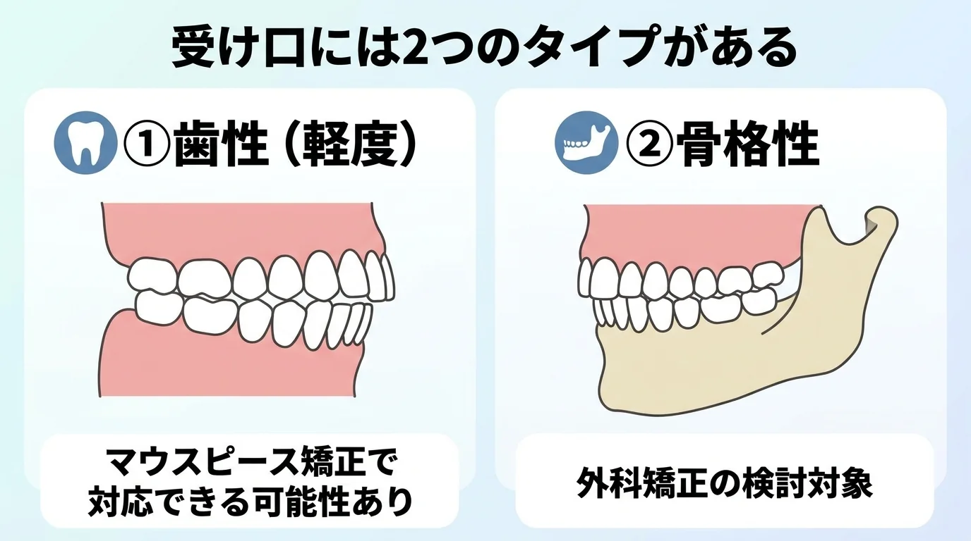 受け口の2タイプを対比した図解。左側『歯性（軽度）』は下の前歯が前方に傾いているイラストと『マウスピース矯正で対応できる可能性あり』のラベル。右側『骨格性』は下顎の骨そのものが前に出ているイラストと『外科矯正の検討対象』のラベル。中央上部に見出し『受け口には2つのタイプがある』