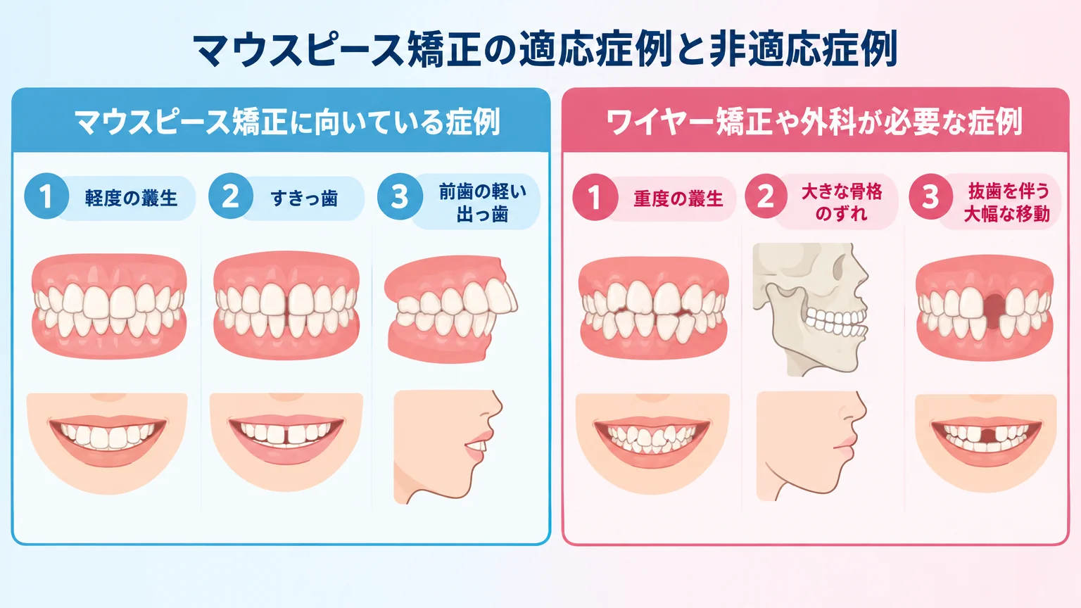 マウスピース矯正の適応症例と非適応症例を対比したイラスト。左側(向いている)に軽度の叢生・すきっ歯・前歯の軽い出っ歯のイラスト、右側(ワイヤー矯正や外科が必要)に重度の叢生・大きな骨格のずれ・抜歯を伴う大幅な移動のイラストを配置