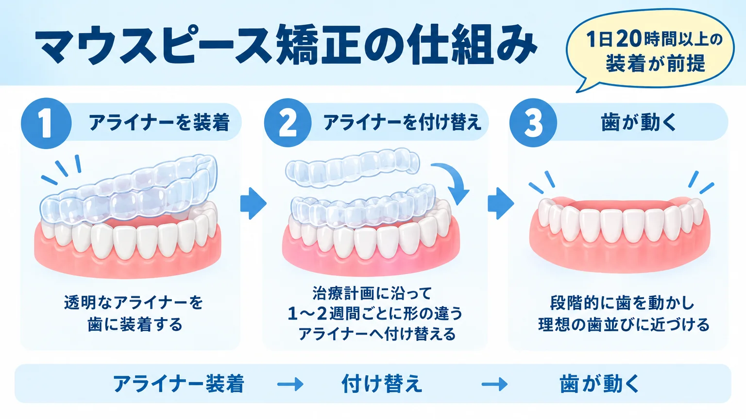 マウスピース矯正の仕組みを示すイラスト図解。透明なアライナーを歯に装着し、治療計画に沿って1〜2週間ごとに形の違うアライナーへ付け替えて段階的に歯を動かす流れを、ステップ1→2→3の歯列イラストで表現。1日20時間以上の装着が前提である旨を吹き出しで注記