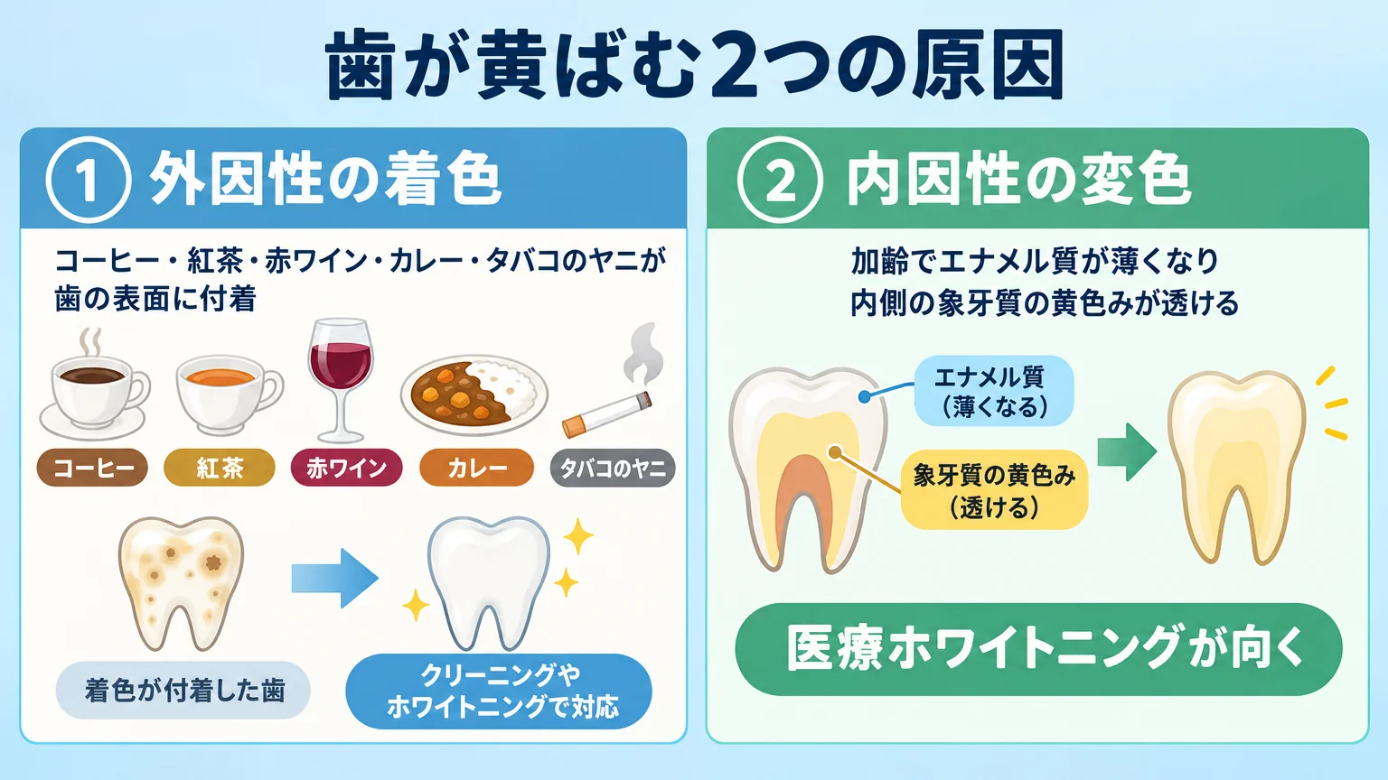 歯が黄ばむ2つの原因の図解。左:外因性の着色(コーヒー・紅茶・赤ワイン・カレー・タバコのヤニが歯の表面に付着)→クリーニングやホワイトニングで対応。右:内因性の変色(加齢でエナメル質が薄くなり内側の象牙質の黄色みが透ける)→医療ホワイトニングが向く