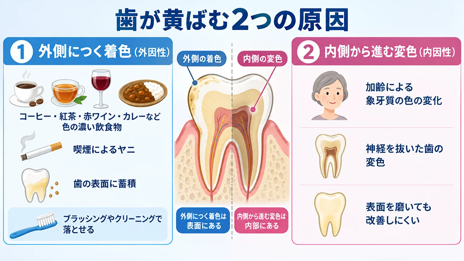 歯が黄ばむ2つの原因を図解したイラスト。左側:外側につく着色(外因性)=コーヒー・紅茶・赤ワイン・カレーなど色の濃い飲食物、喫煙によるヤニ、歯の表面に蓄積・ブラッシングやクリーニングで落とせる。右側:内側から進む変色(内因性)=加齢による象牙質の色の変化、神経を抜いた歯の変色、表面を磨いても改善しにくい。歯の断面図で着色の位置の違いを示す