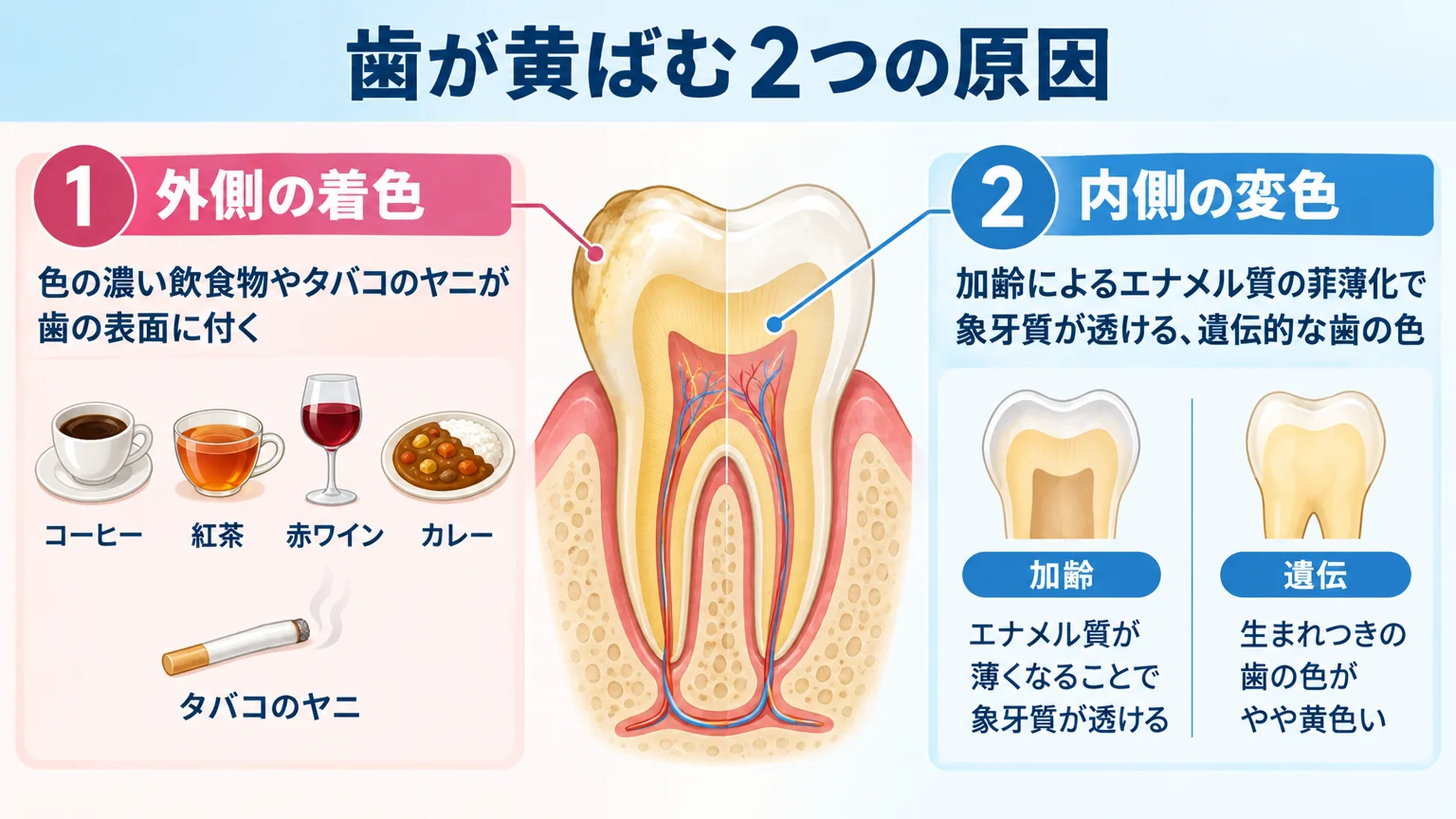 歯が黄ばむ2つの原因を図解したイラスト。外側の着色(コーヒー・紅茶・赤ワイン・カレーなど色の濃い飲食物、タバコのヤニ)と内側の変色(加齢によるエナメル質の菲薄化で象牙質が透ける、遺伝的な歯の色)を左右に分けて、歯の断面図とともに示したイラスト
