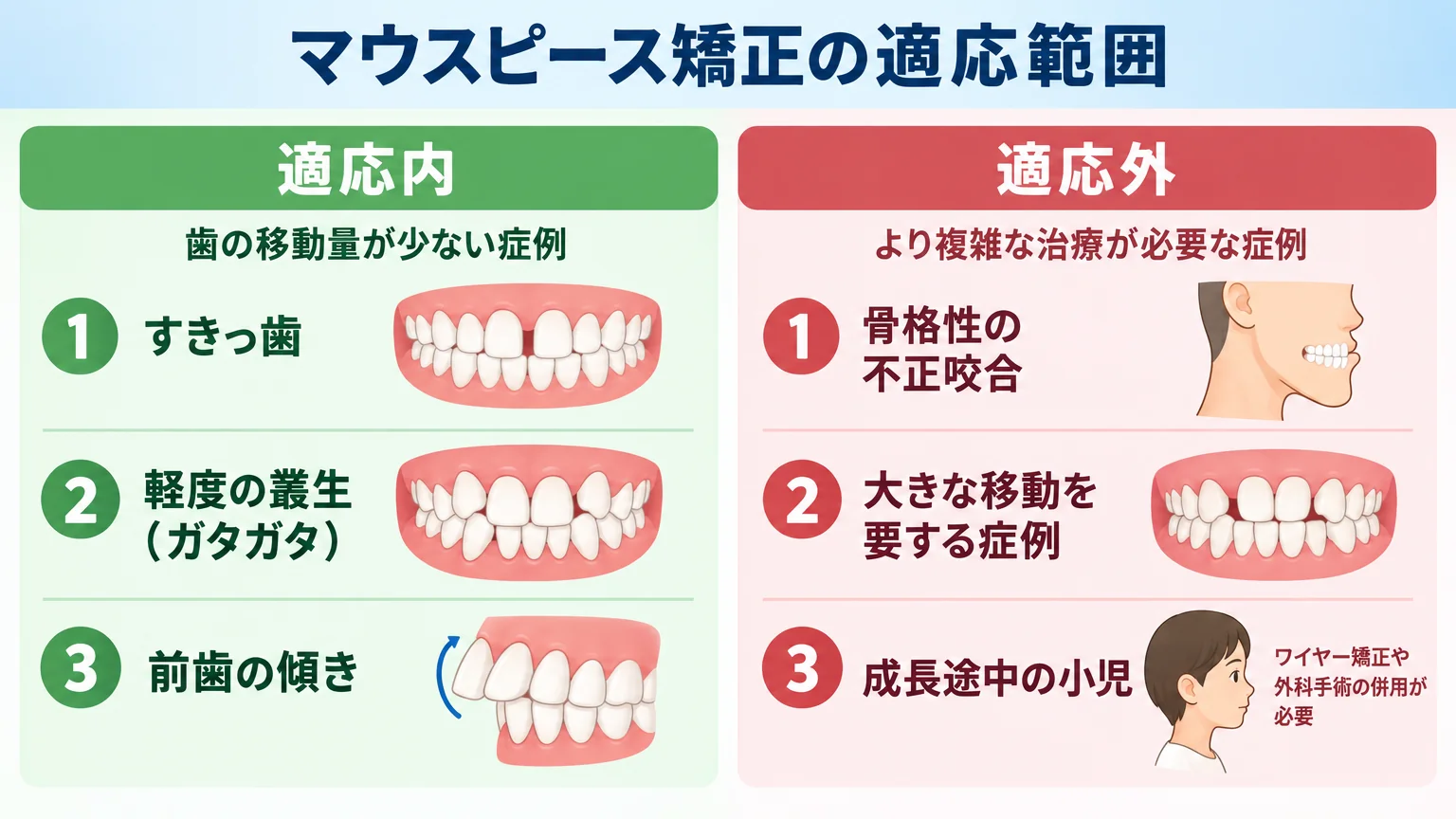 マウスピース矯正の適応範囲の線引き図。適応内＝すきっ歯・軽度の叢生（ガタガタ）・前歯の傾きなど歯の移動量が少ない症例。適応外＝骨格性の不正咬合・大きな移動を要する症例・成長途中の小児（ワイヤー矯正や外科手術の併用が必要）。左右2カラムで対比したイラスト