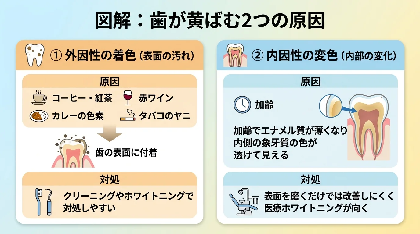歯が黄ばむ2つの原因を示す図解。外因性の着色:コーヒー・紅茶・赤ワイン・カレーの色素やタバコのヤニが歯の表面に付着・クリーニングやホワイトニングで対処しやすい、内因性の変色:加齢でエナメル質が薄くなり内側の象牙質の色が透けて見える・表面を磨くだけでは改善しにくく医療ホワイトニングが向く、という2タイプの対比イラスト