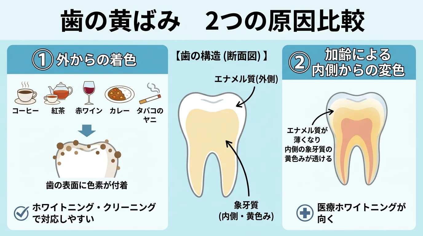 歯が黄ばむ2つの原因を比較するインフォグラフィック。左『外からの着色』：コーヒー・紅茶・赤ワイン・カレー・タバコのヤニのアイコン、歯の表面に色素が付着、ホワイトニング・クリーニングで対応しやすい。右『加齢による内側からの変色』：エナメル質が薄くなり内側の象牙質の黄色みが透ける断面図、医療ホワイトニングが向く。中央に歯の構造（エナメル質・象牙質）の断面図