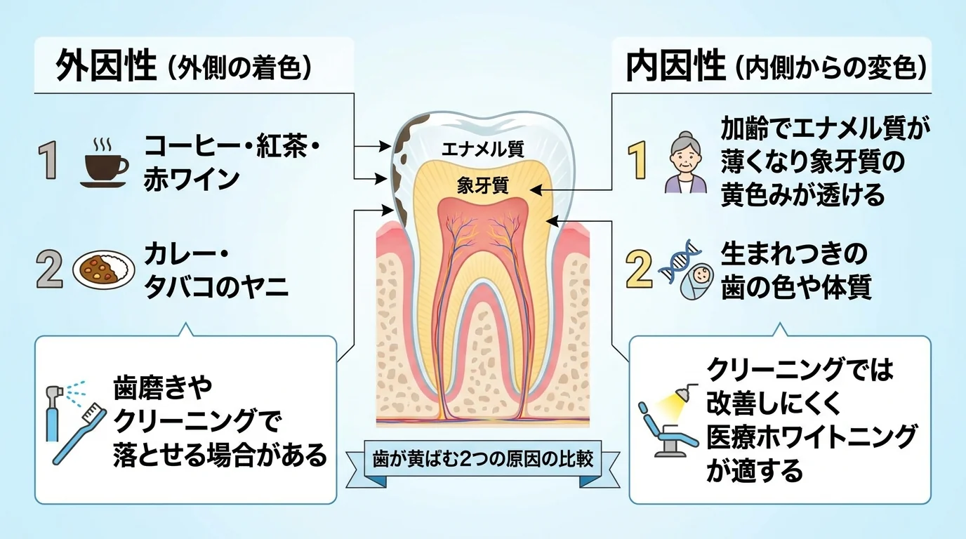 歯が黄ばむ2つの原因を比較するインフォグラフィック。左「外因性（外側の着色）」：コーヒー・紅茶・赤ワイン・カレー・タバコのヤニが原因、歯磨きやクリーニングで落とせる場合がある。右「内因性（内側からの変色）」：加齢でエナメル質が薄くなり象牙質の黄色みが透ける・生まれつきの歯の色や体質が原因、クリーニングでは改善しにくく医療ホワイトニングが適する。中央に歯の断面図を配置