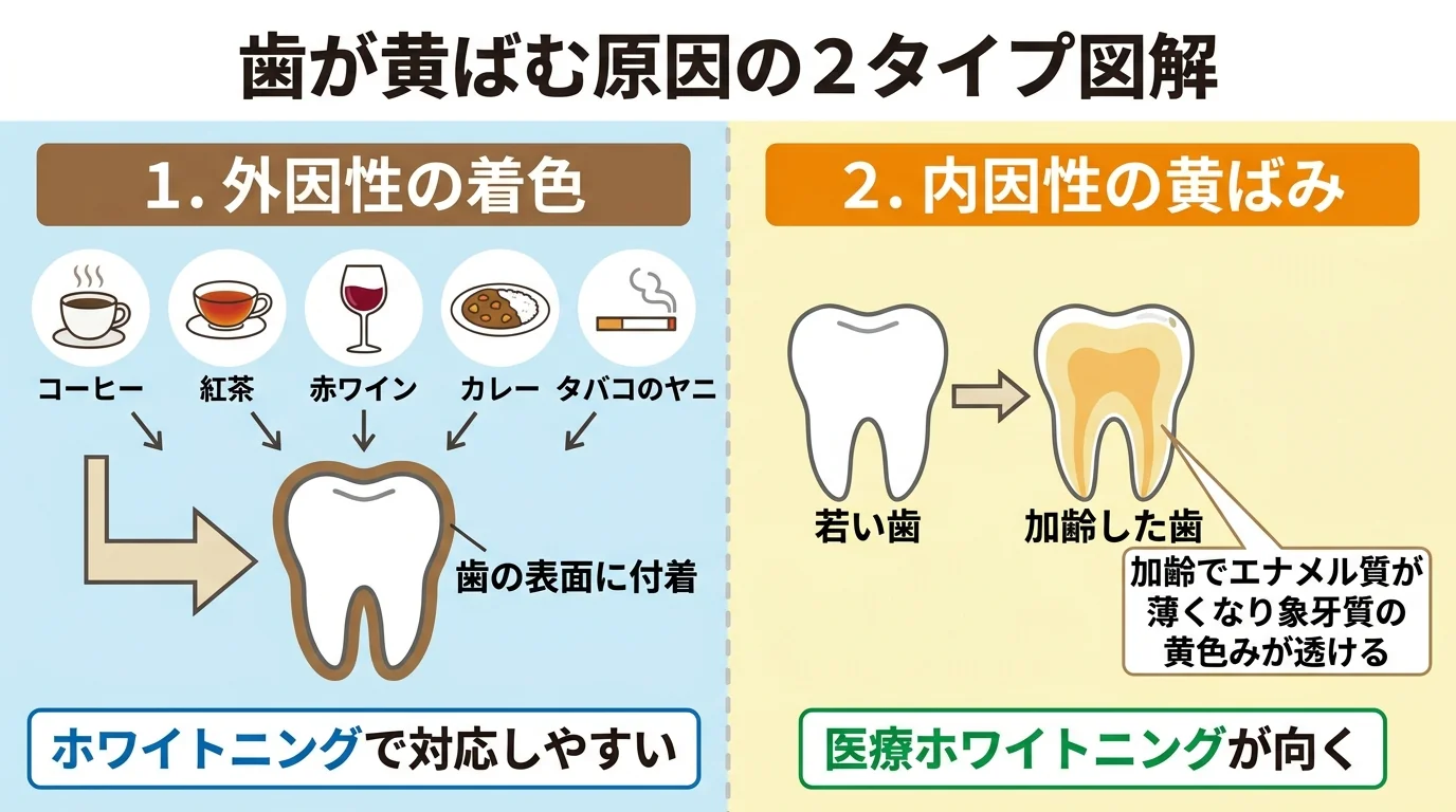 歯が黄ばむ原因を2タイプに分けて図解したイラスト。左側「外因性の着色」コーヒー・紅茶・赤ワイン・カレー・タバコのヤニ→歯の表面に付着(ホワイトニングで対応しやすい)。右側「内因性の黄ばみ」加齢でエナメル質が薄くなり象牙質の黄色みが透ける(医療ホワイトニングが向く)