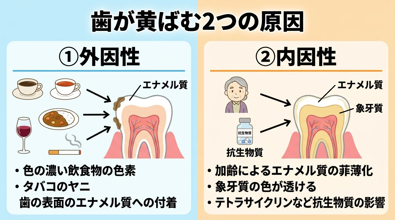 歯が黄ばむ原因を外因性と内因性に分けて示した説明イラスト。外因性：コーヒー・紅茶・赤ワイン・カレーなど色の濃い飲食物の色素、タバコのヤニが歯の表面のエナメル質に付着。内因性：加齢によるエナメル質の菲薄化で象牙質の色が透ける、テトラサイクリンなど抗生物質の影響。タイトルは『歯が黄ばむ2つの原因』