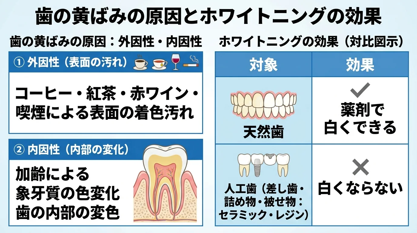 歯の黄ばみの原因を外因性と内因性に分けて解説するイラスト。外因性＝コーヒー・紅茶・赤ワイン・喫煙による表面の着色汚れ、内因性＝加齢による象牙質の色の変化・歯の内部の変色。あわせて天然歯は薬剤で白くできる／差し歯・詰め物・被せ物（セラミック・レジン）は白くならないことを対比して図示
