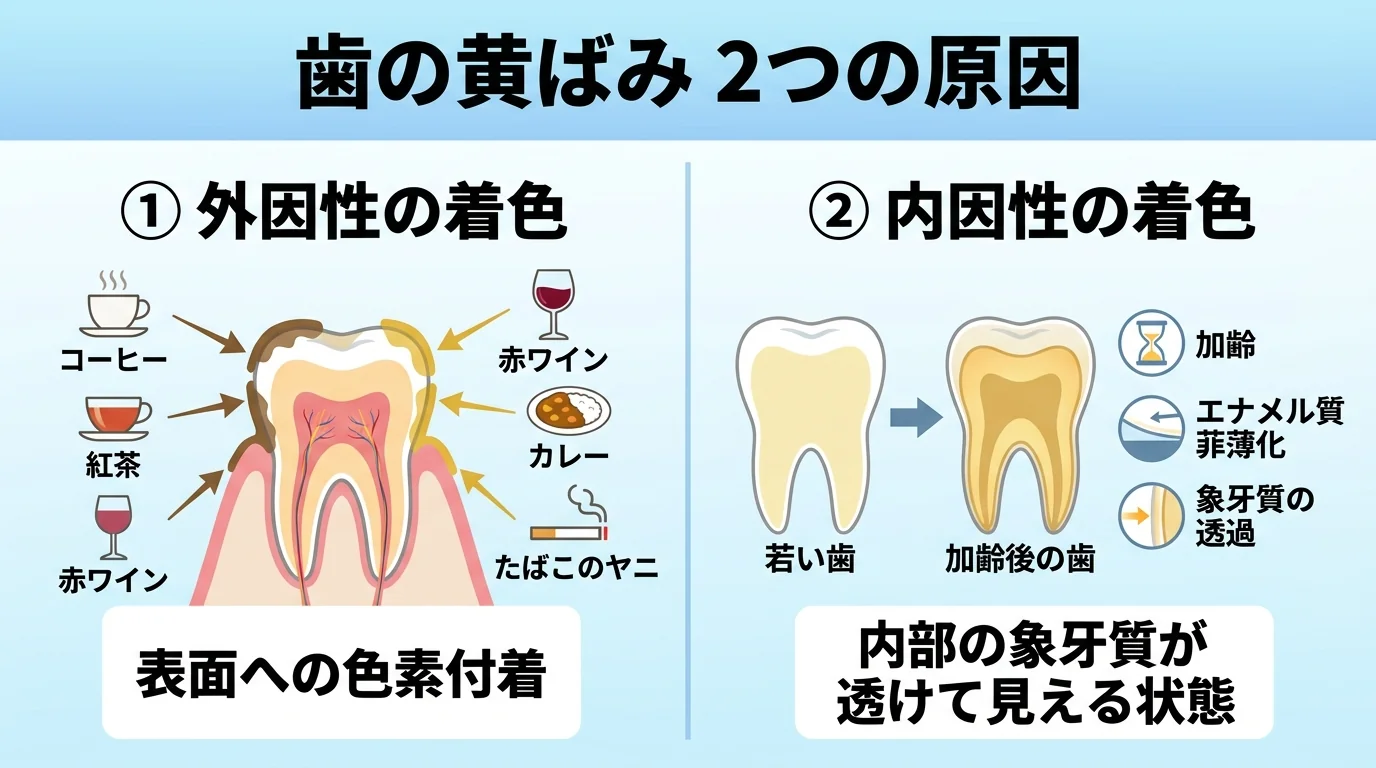 歯が黄ばむ2種類の原因を図解するイラスト。左側『外因性の着色』:コーヒー・紅茶・赤ワイン・カレー・たばこのヤニが歯の表面に色素として付着する様子。右側『内因性の着色』:加齢でエナメル質が薄くなり内側の象牙質の黄色みが透けて見える断面図。タイトルは『歯の黄ばみ 2つの原因』