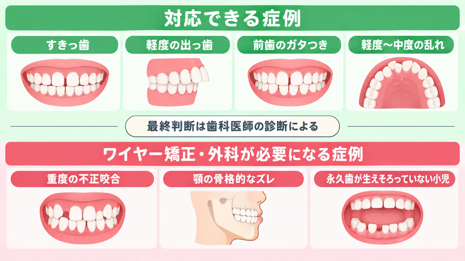 マウスピース矯正の適応症例の早見イラスト。上段「対応できる症例」（緑系）：すきっ歯、軽度の出っ歯、前歯のガタつき、軽度〜中度の乱れ。下段「ワイヤー矯正・外科が必要になる症例」（赤系）：重度の不正咬合、顎の骨格的なズレ、永久歯が生えそろっていない小児。中央に『最終判断は歯科医師の診断による』と注記