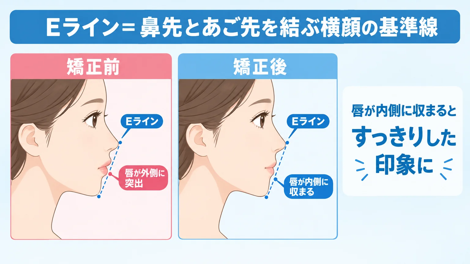 横顔のEラインを示すイラスト。鼻先とあご先を結んだ直線（Eライン）に対し、矯正前は唇が線の外側に突出し、矯正後は唇が線の内側に収まる様子をビフォーアフターで並べた図。『Eライン＝鼻先とあご先を結ぶ横顔の基準線』『唇が内側に収まるとすっきりした印象に』のキャプション付き