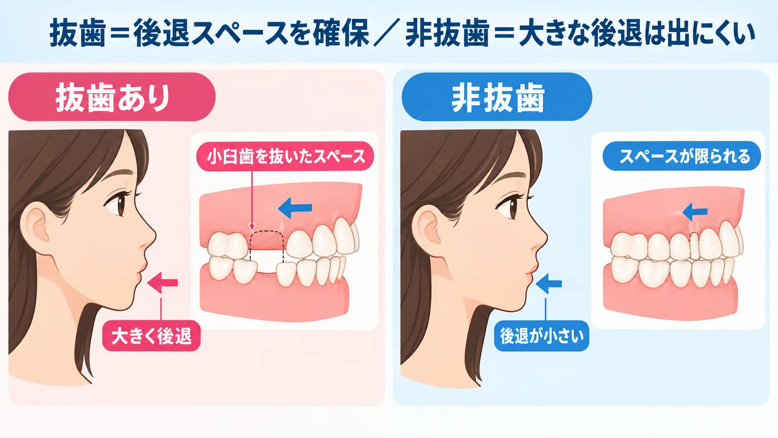 抜歯と非抜歯で口元の後退量がどう変わるかを示す横顔イラスト比較図。左『抜歯あり』は小臼歯を抜いたスペースを使って前歯を大きく後退させ口元がしっかり下がる様子、右『非抜歯』はスペースが限られ前歯の後退が小さい様子を矢印付きで対比。キャプション『抜歯＝後退スペースを確保／非抜歯＝大きな後退は出にくい』