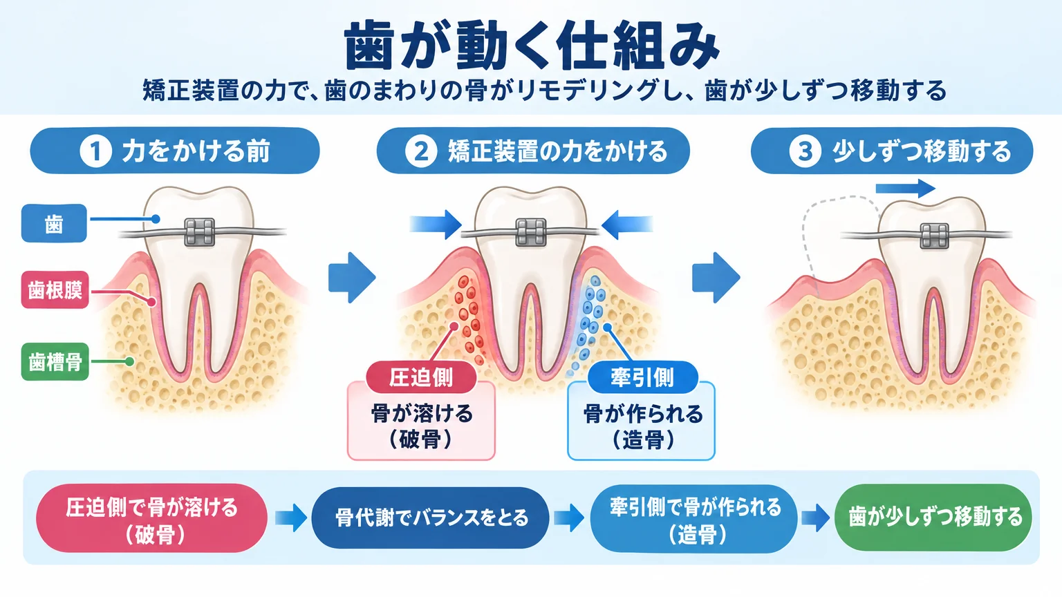 歯が動く仕組みを示すイラスト。歯・歯根膜・歯槽骨の断面図で、矯正装置の力をかけると『圧迫側で骨が溶ける（破骨）』『牽引側で骨が作られる（造骨）』という骨代謝で歯が少しずつ移動する流れを矢印付きで図解