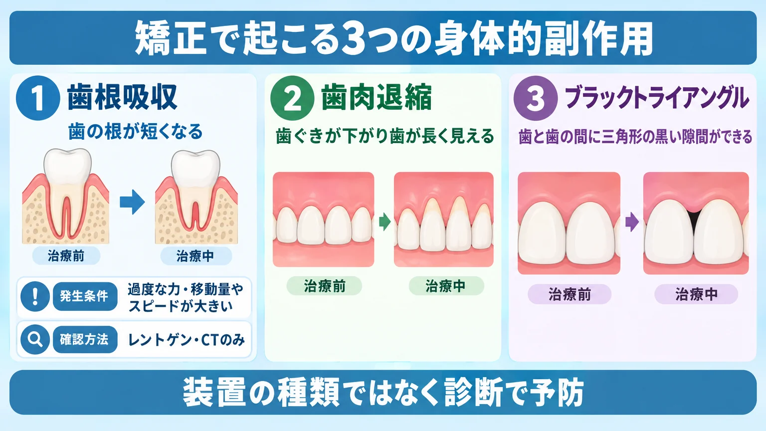 矯正で起こる3つの身体的副作用を図解するイラスト。①歯根吸収＝歯の根が短くなる断面図、発生条件『過度な力・移動量やスピードが大きい』、確認はレントゲン・CTのみ。②歯肉退縮＝歯ぐきが下がり歯が長く見える図。③ブラックトライアングル＝歯と歯の間に三角形の黒い隙間ができる図。全体に『装置の種類ではなく診断で予防』の注記