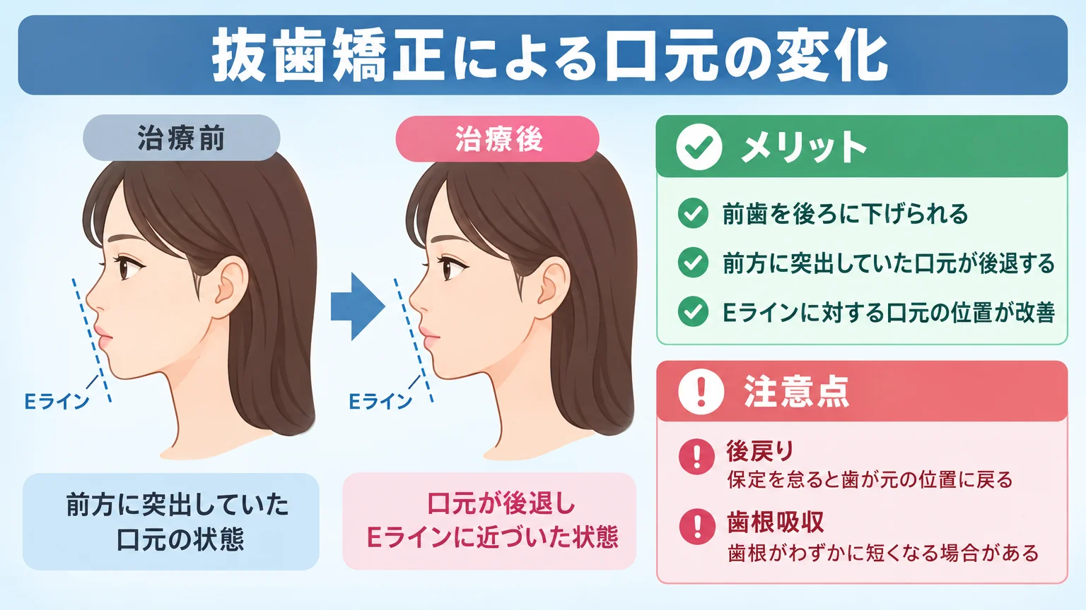 抜歯矯正による口元の変化を横顔イラストで示す図。『抜歯で前歯を後ろに下げると、前方に突出していた口元が後退し、Eライン（鼻先と顎先を結んだ線）に対する口元の位置が改善』というメリットと、『後戻り（保定を怠ると歯が元の位置に戻る）』『歯根吸収（歯根がわずかに短くなる場合がある）』という注意点を併記する