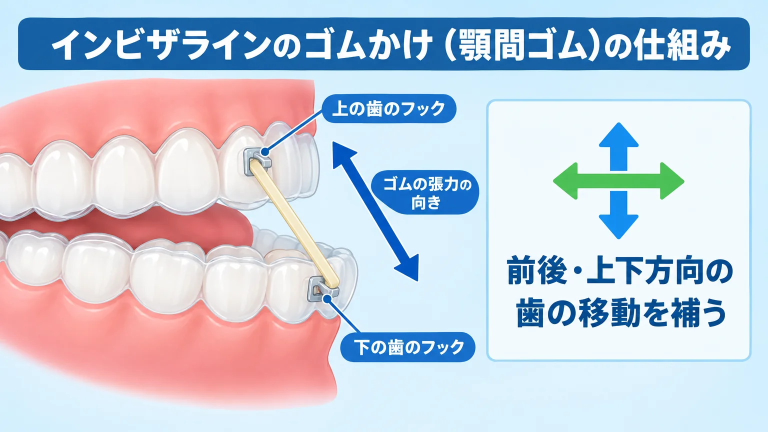 インビザラインのゴムかけ(顎間ゴム)の仕組みを示すイラスト。上の歯のフックから下の歯のフックへ斜めに医療用ゴムがかかっている図。ゴムの張力の向きを矢印で示し『前後・上下方向の歯の移動を補う』というキャプションを添える