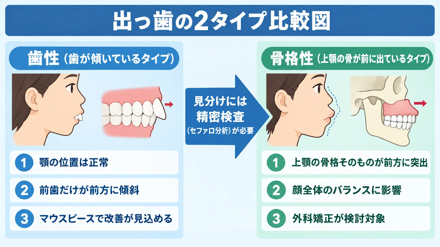 出っ歯の2タイプ比較図。左『歯性(歯が傾いているタイプ)』:顎の位置は正常、前歯だけが前方に傾斜、マウスピースで改善が見込める。右『骨格性(上顎の骨が前に出ているタイプ)』:上顎の骨格そのものが前方に突出、外科矯正が検討対象。中央に矢印で『見分けには精密検査(セファロ分析)が必要』と記載