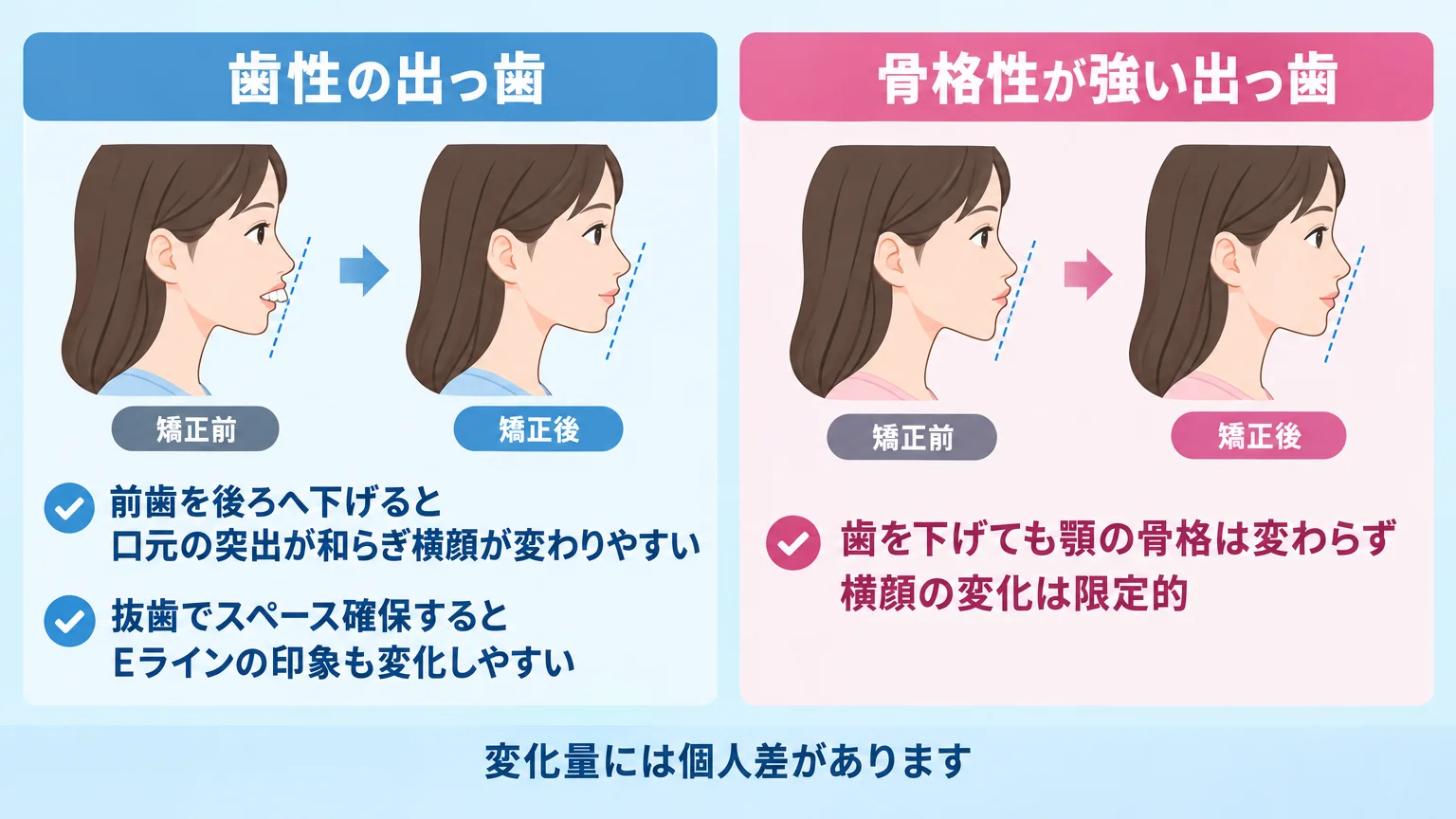出っ歯矯正による横顔(Eライン)の変化を歯性・骨格性で比較するイラスト。左『歯性の出っ歯』:前歯を後ろへ下げると口元の突出が和らぎ横顔が変わりやすい、抜歯でスペース確保するとEラインの印象も変化しやすい。右『骨格性が強い出っ歯』:歯を下げても顎の骨格は変わらず横顔の変化は限定的。下部に注記『変化量には個人差があります』
