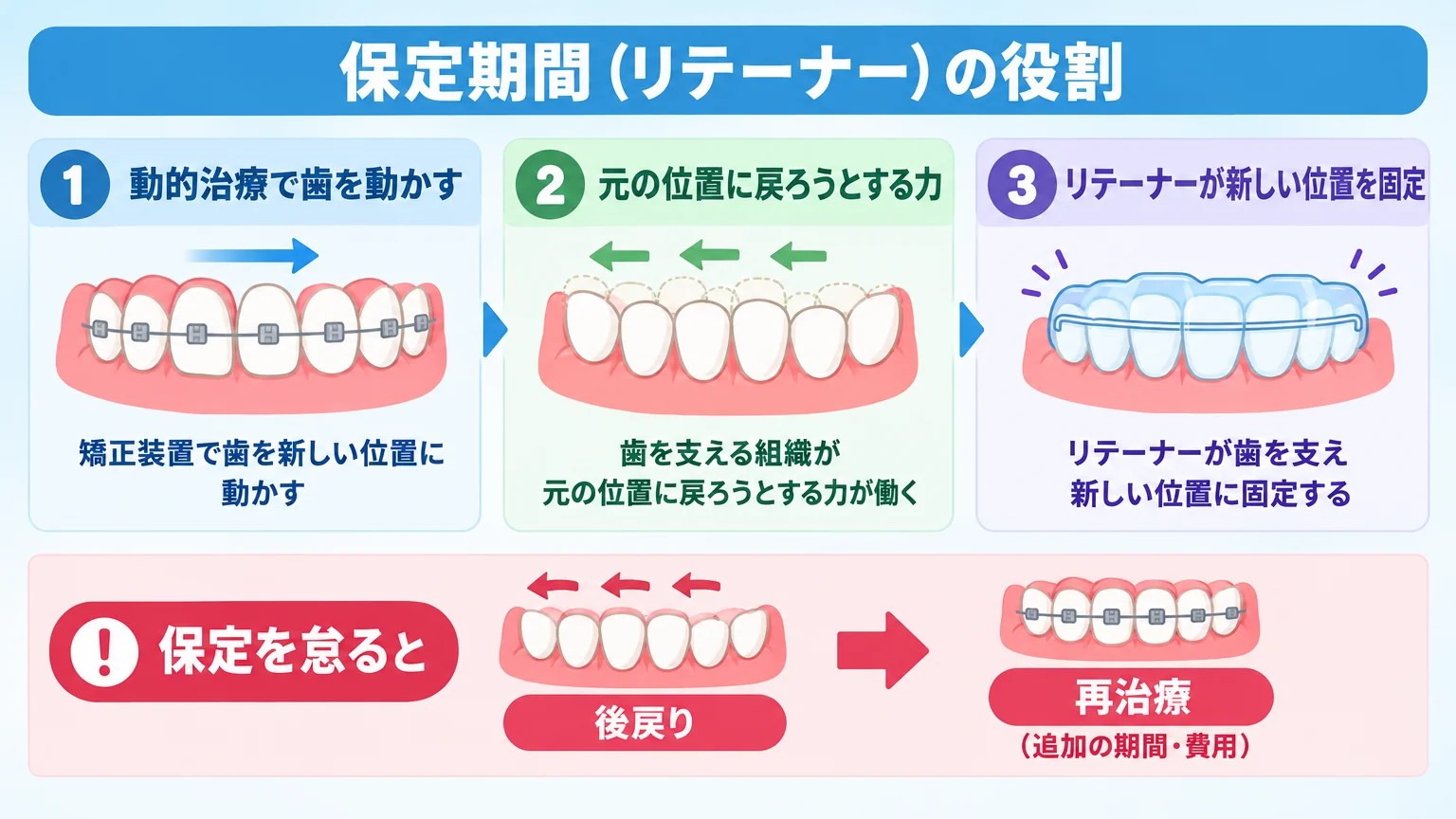 保定期間(リテーナー)の役割を示すイラスト。動的治療で動かした歯が元の位置へ戻ろうとする力に対し、リテーナーが新しい位置に固定する様子を図解。『保定を怠ると後戻り→再治療(追加の期間・費用)』という注意フローも添える