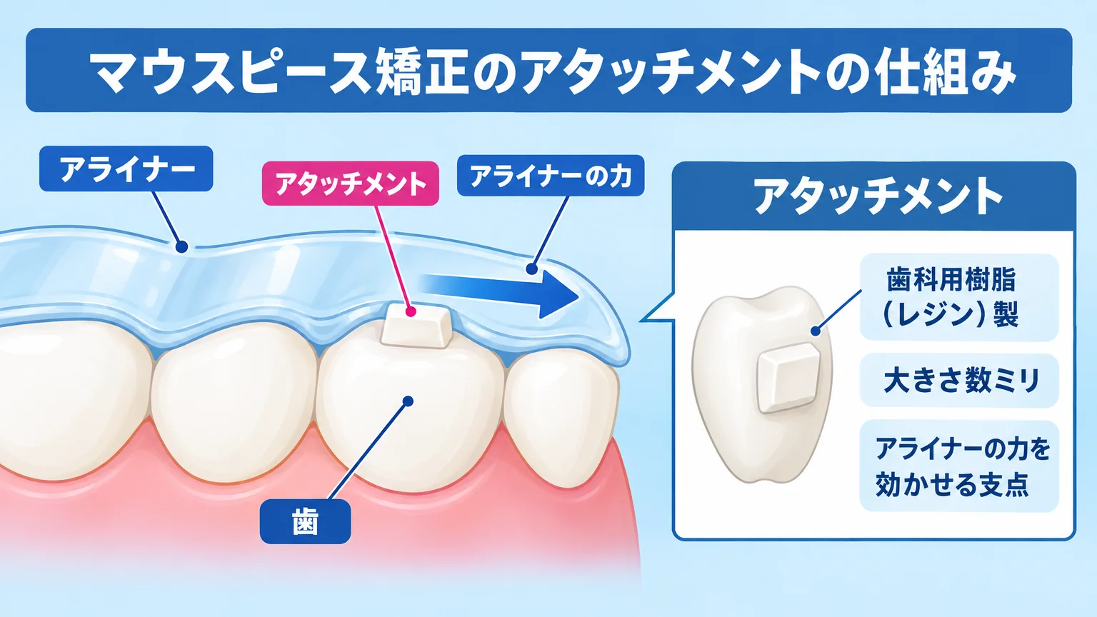 マウスピース矯正のアタッチメントの仕組みを示すイラスト。歯の表面に小さな白い突起(アタッチメント)が付き、その上から透明なアライナーが被さる断面図。突起が『支点』となってアライナーの力を特定方向に伝える様子を矢印で示す。ラベル『アタッチメント=歯科用樹脂(レジン)製/大きさ数ミリ/アライナーの力を効かせる支点』