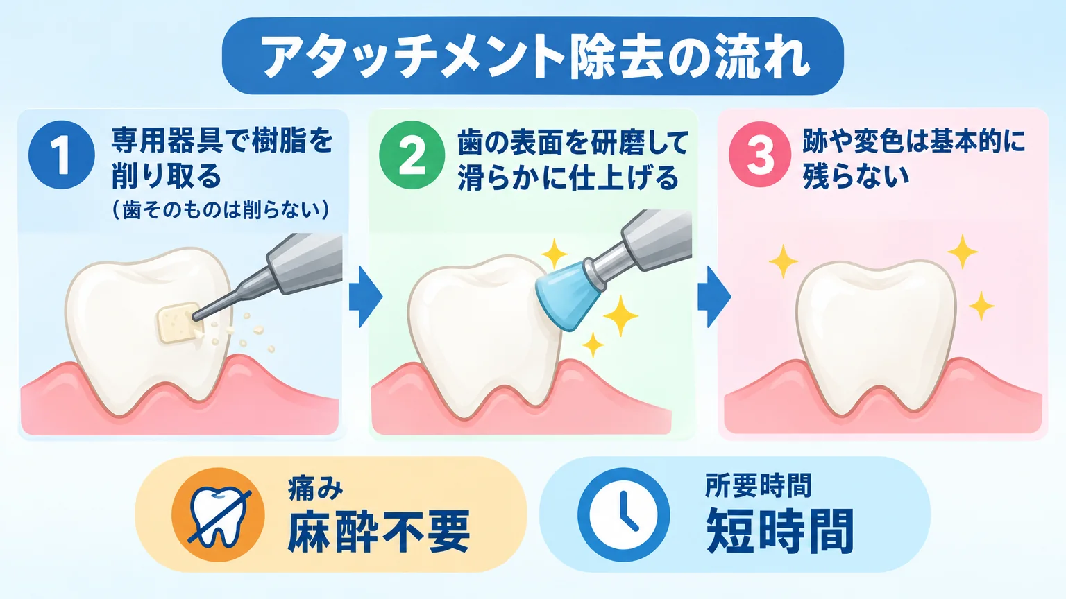 アタッチメント除去の流れを示すイラスト。ステップ1『専用器具で樹脂を削り取る(歯そのものは削らない)』→ステップ2『歯の表面を研磨して滑らかに仕上げる』→ステップ3『跡や変色は基本的に残らない』の3ステップ。痛み=麻酔不要/所要時間=短時間というラベル付き