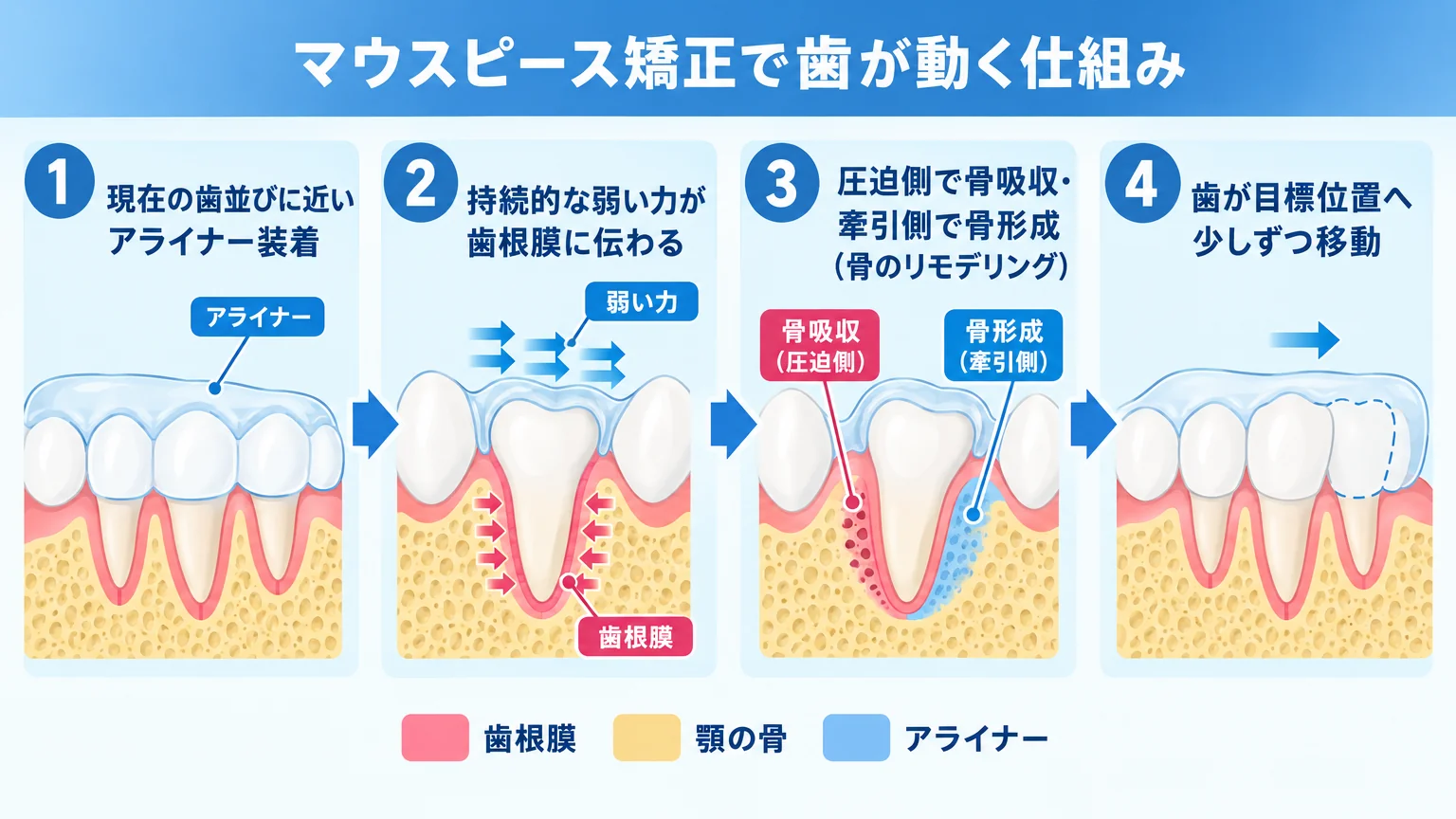 マウスピース矯正で歯が動く仕組みの図解。左から『①現在の歯並びに近いアライナー装着』→『②持続的な弱い力が歯根膜に伝わる』→『③圧迫側で骨吸収・牽引側で骨形成（骨のリモデリング）』→『④歯が目標位置へ少しずつ移動』の4ステップを矢印で連結。歯根膜・顎の骨・アライナーを色分けしたイラスト