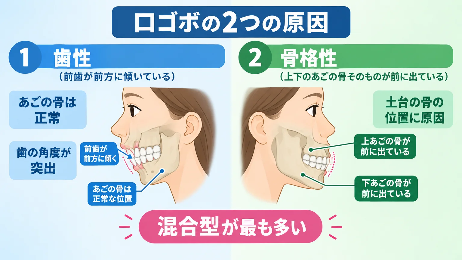 口ゴボの2つの原因を比較するイラスト図。左側に『歯性（前歯が前方に傾いている）あごの骨は正常・歯の角度が突出』、右側に『骨格性（上下のあごの骨そのものが前に出ている）土台の骨の位置に原因』を横顔の断面図で対比。中央下に『混合型が最も多い』の注記