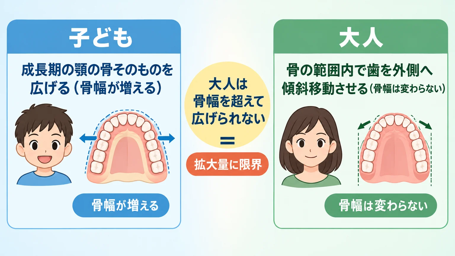 大人と子どもの歯列拡大の違いを示すイラスト。左側に『子ども：成長期の顎の骨そのものを広げる（骨幅が増える）』、右側に『大人：骨の範囲内で歯を外側へ傾斜移動させる（骨幅は変わらない）』を対比。中央に『大人は骨幅を超えて広げられない＝拡大量に限界』の注記
