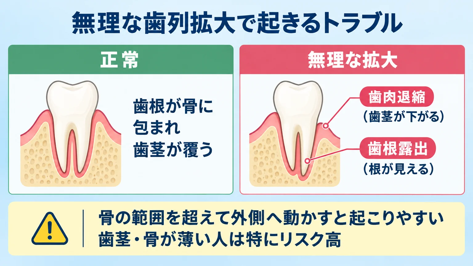 無理な歯列拡大で起きるトラブルの図解。歯の断面イラストで『正常：歯根が骨に包まれ歯茎が覆う』と『無理な拡大：歯根が骨からはみ出し→歯肉退縮（歯茎が下がる）・歯根露出（根が見える）』を対比。注記『骨の範囲を超えて外側へ動かすと起こりやすい／歯茎・骨が薄い人は特にリスク高』