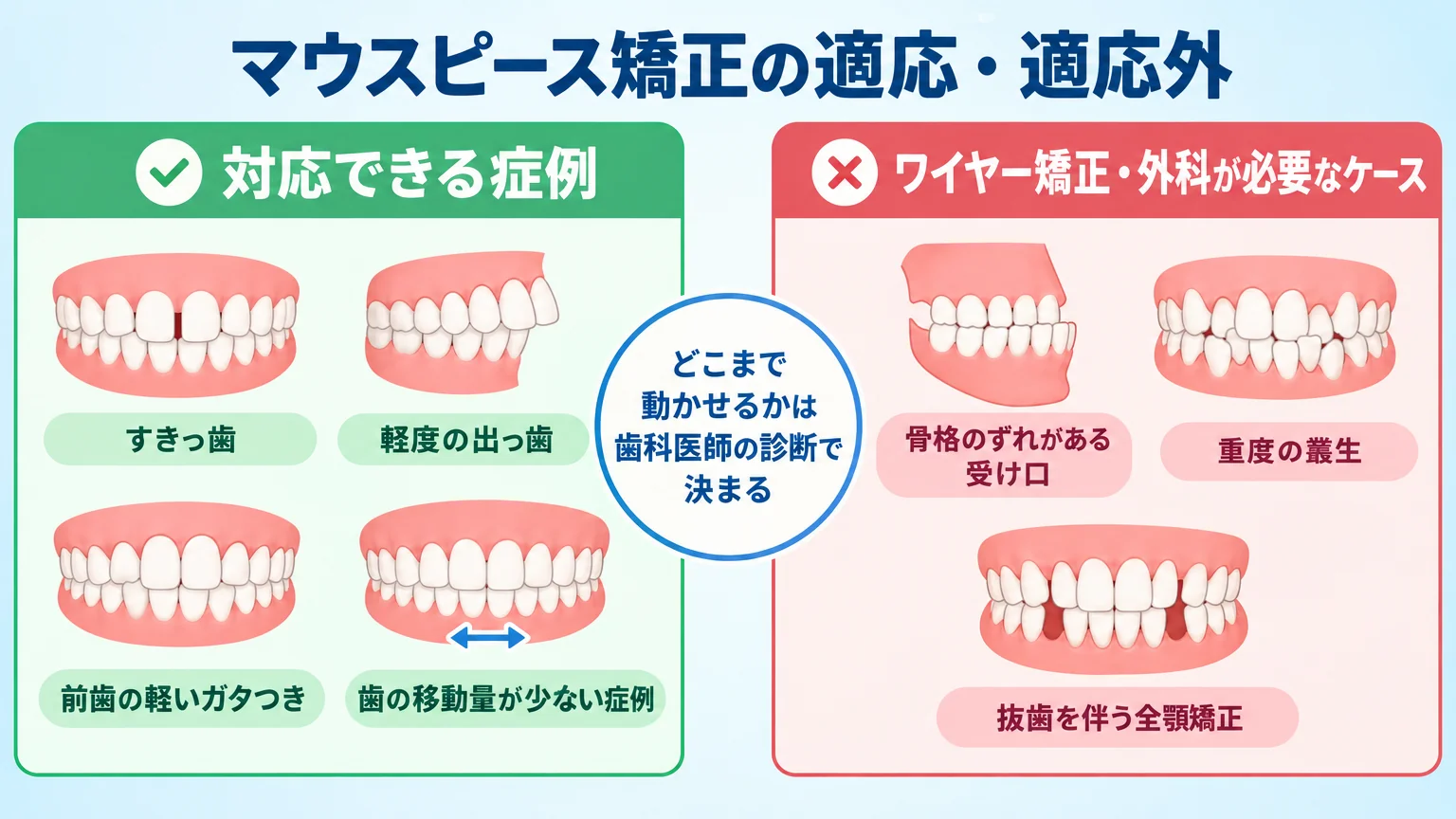 マウスピース矯正の適応症例と適応外症例の対比イラスト。左側『対応できる症例』:すきっ歯、軽度の出っ歯、前歯の軽いガタつき、歯の移動量が少ない症例。右側『ワイヤー矯正・外科が必要なケース』:骨格のずれがある受け口、重度の叢生、抜歯を伴う全顎矯正。中央に『どこまで動かせるかは歯科医師の診断で決まる』の注記。タイトル『マウスピース矯正の適応・適応外』