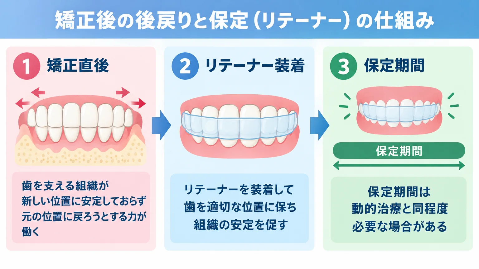 矯正後の後戻りと保定(リテーナー)の仕組みを示すイラスト。矯正直後は歯を支える組織が新しい位置に安定しておらず元の位置に戻ろうとする力が働くこと、リテーナー装着で安定させること、保定期間は動的治療と同程度必要な場合があることを時系列のフロー図で解説