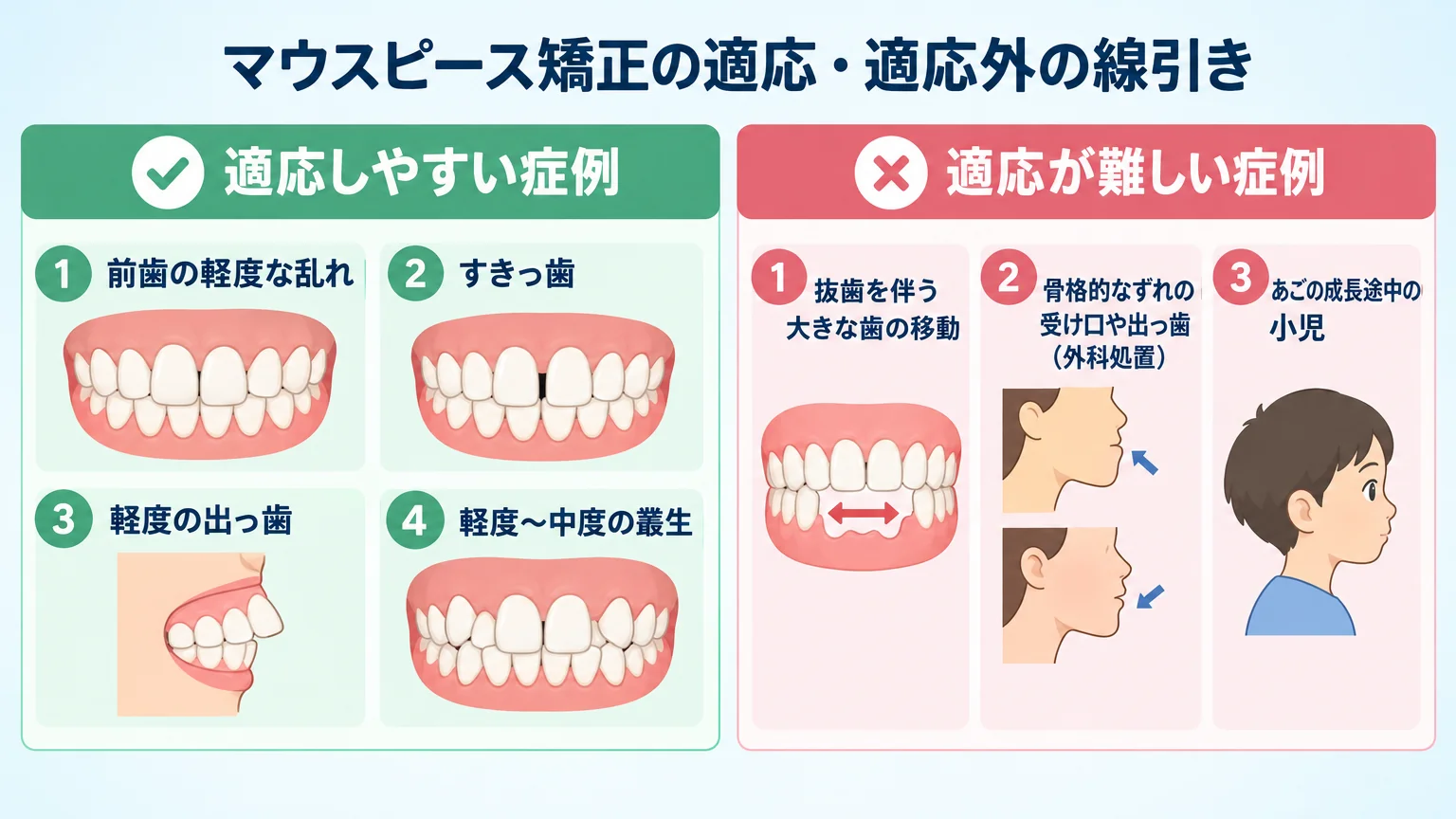 マウスピース矯正の適応・適応外の線引き図。適応しやすい症例=前歯の軽度な乱れ・すきっ歯・軽度の出っ歯・軽度〜中度の叢生/適応が難しい症例=抜歯を伴う大きな歯の移動・骨格的なずれの受け口や出っ歯(外科処置)・あごの成長途中の小児。左右2列の比較イラスト