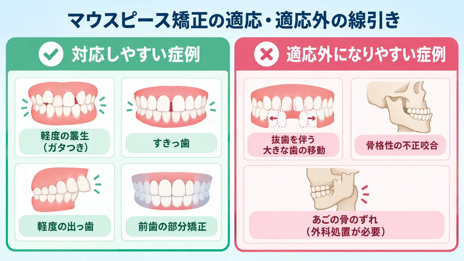 マウスピース矯正の適応・適応外の線引きを示すイラスト。対応しやすい症例=軽度の叢生(ガタつき)・すきっ歯・軽度の出っ歯・前歯の部分矯正、適応外になりやすい症例=抜歯を伴う大きな歯の移動・骨格性の不正咬合・あごの骨のずれ(外科処置が必要)、を左右に対比したフロー図