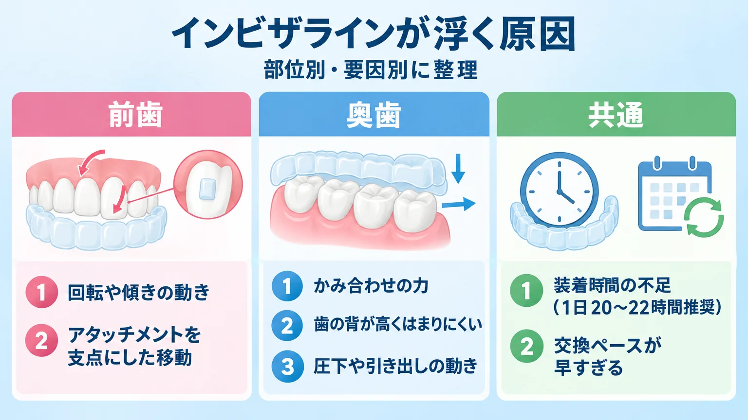 インビザラインが浮く原因を部位別・要因別に整理したインフォグラフィック。『前歯=回転や傾きの動き・アタッチメントを支点にした移動』『奥歯=かみ合わせの力・歯の背が高くはまりにくい・圧下や引き出しの動き』『共通=装着時間の不足(1日20〜22時間推奨)・交換ペースが早すぎる』の3ブロック構成