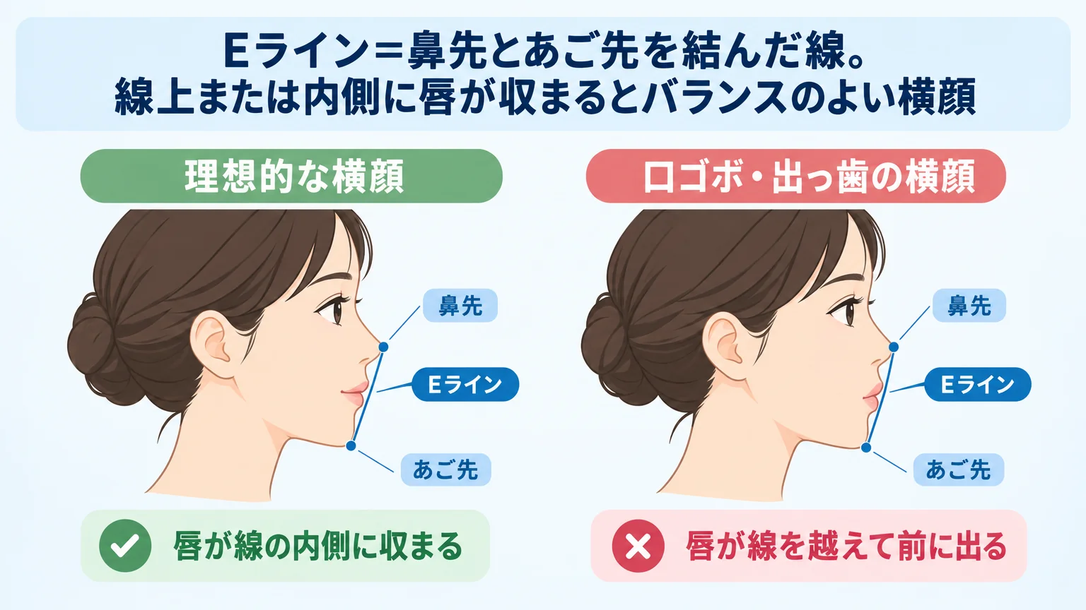 Eラインの概念図。横顔のイラストに鼻先とあご先を結んだ直線を引き、唇が線の内側に収まる『理想的な横顔』と、唇が線を越えて前に出る『口ゴボ・出っ歯の横顔』の2パターンを左右に並べて比較。キャプション『Eライン=鼻先とあご先を結んだ線。線上または内側に唇が収まるとバランスのよい横顔』