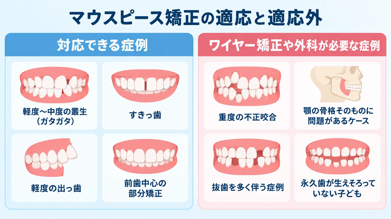 マウスピース矯正の適応と適応外を分けたイラスト図。対応できる症例:軽度〜中度の叢生(ガタガタ)・すきっ歯・軽度の出っ歯・前歯中心の部分矯正。ワイヤー矯正や外科が必要な症例:重度の不正咬合・顎の骨格そのものに問題があるケース・抜歯を多く伴う症例・永久歯が生えそろっていない子ども