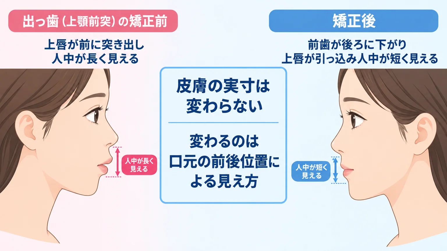 歯列矯正による人中の見え方の変化を示すイラスト。左側に「出っ歯（上顎前突）の矯正前：上唇が前に突き出し人中が長く見える」、右側に「矯正後：前歯が後ろに下がり上唇が引っ込み人中が短く見える」の2枚の横顔比較図。中央に「皮膚の実寸は変わらない／変わるのは口元の前後位置による見え方」の注記