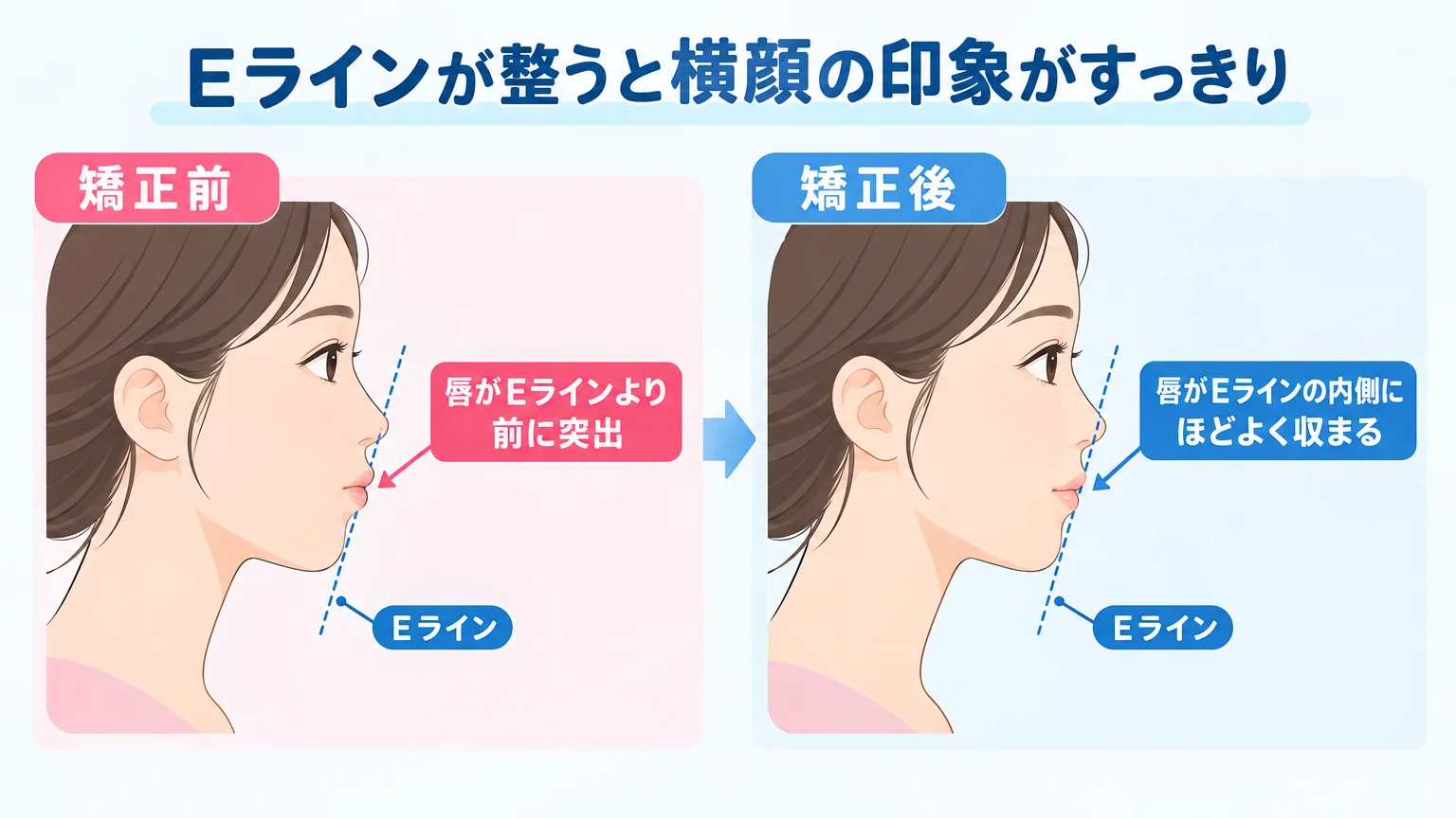 横顔のEライン（鼻先とあご先を結んだ直線）に対する唇の位置を示すイラスト。矯正前は唇がEラインより前に突出、矯正後は唇が内側にほどよく収まる2パターンを左右に並べ、『Eラインが整うと横顔の印象がすっきり』というキャプションを添える