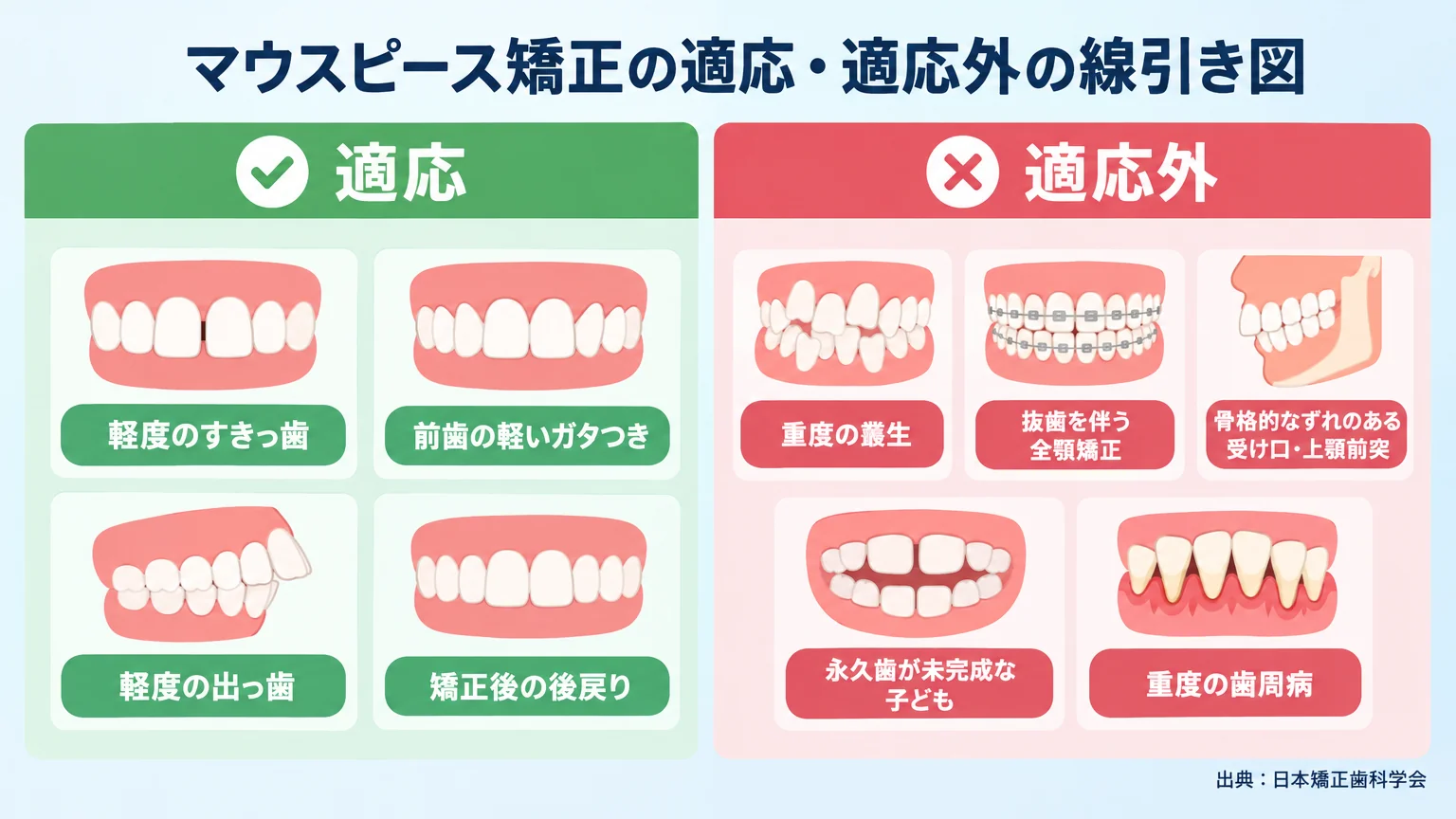 マウスピース矯正の適応・適応外の線引き図。適応(緑):軽度のすきっ歯、前歯の軽いガタつき、軽度の出っ歯、矯正後の後戻り。適応外(赤):重度の叢生、抜歯を伴う全顎矯正、骨格的なずれのある受け口・上顎前突、永久歯が未完成な子ども、重度の歯周病。出典:日本矯正歯科学会