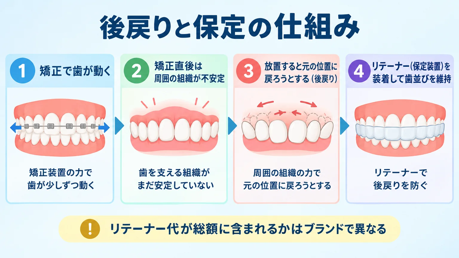 後戻りと保定の仕組みを示すイラスト図。ステップ1:矯正で歯が動く→ステップ2:矯正直後は周囲の組織が不安定→ステップ3:放置すると元の位置に戻ろうとする(後戻り)→ステップ4:リテーナー(保定装置)を装着して歯並びを維持。リテーナー代が総額に含まれるかはブランドで異なる旨の注記