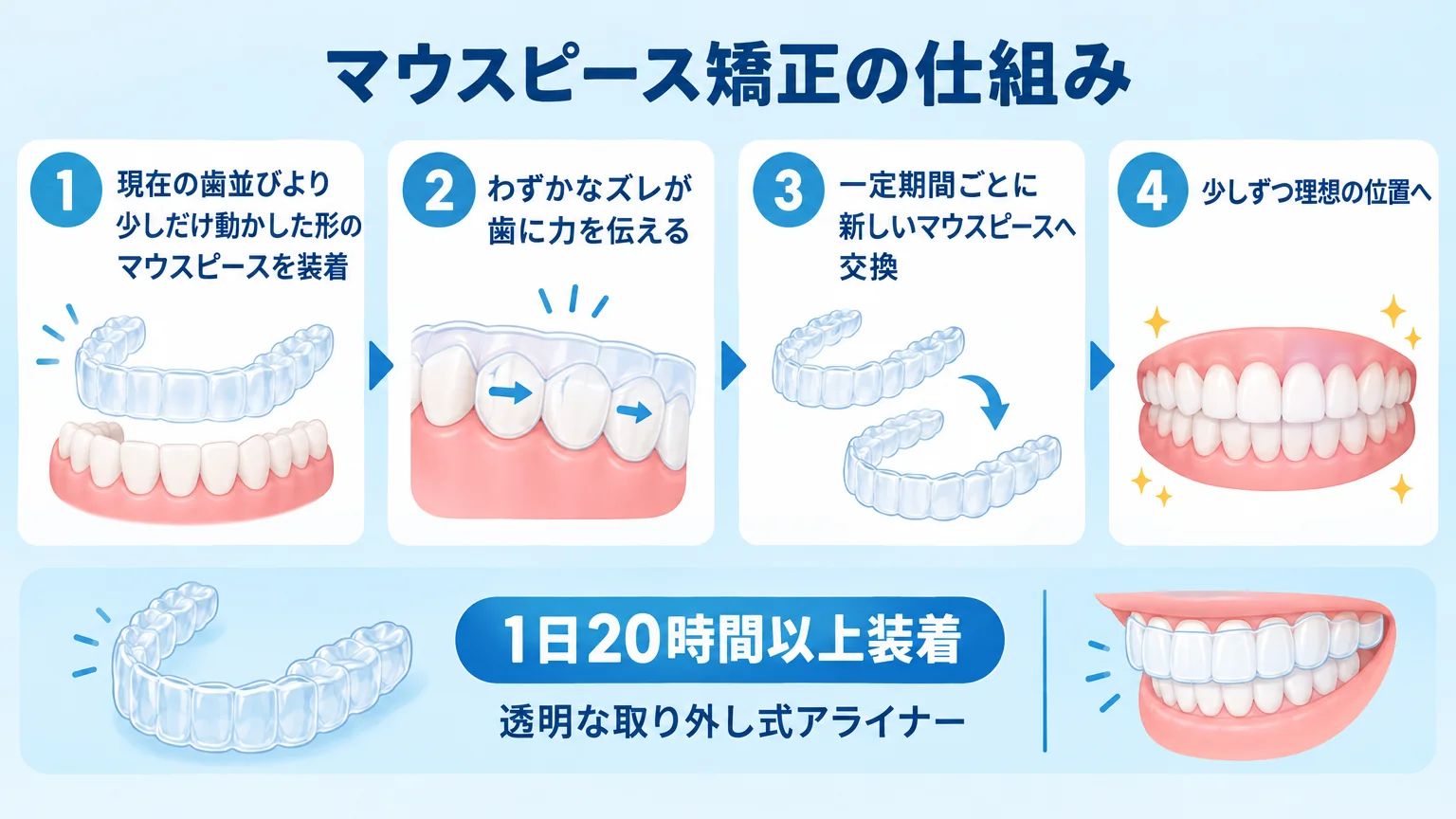 マウスピース矯正の仕組みフロー図。①現在の歯並びより少しだけ動かした形のマウスピースを装着→②わずかなズレが歯に力を伝える→③一定期間ごとに新しいマウスピースへ交換→④少しずつ理想の位置へ。透明な取り外し式アライナーのイラスト付き、1日20時間以上装着と注記