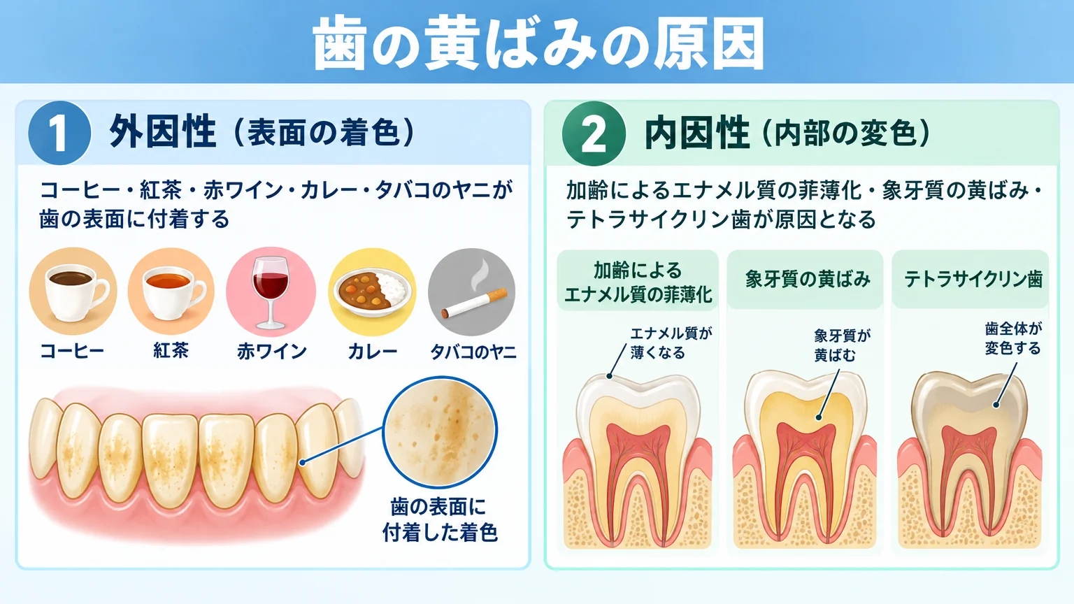 歯の黄ばみの原因を2タイプに分けて示すイラスト。左側に外因性（表面の着色）＝コーヒー・紅茶・赤ワイン・カレー・タバコのヤニが歯の表面に付着するイメージ、右側に内因性（内部の変色）＝加齢によるエナメル質の菲薄化・象牙質の黄ばみ・テトラサイクリン歯を断面図で図解