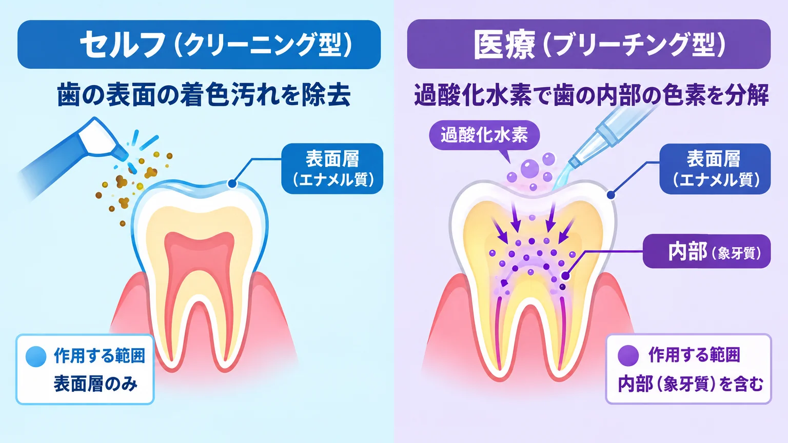 チョコザップのセルフホワイトニングと歯科医院の医療ホワイトニングの作用範囲を対比したイラスト。左側に『セルフ(クリーニング型):歯の表面の着色汚れを除去』、右側に『医療(ブリーチング型):過酸化水素で歯の内部の色素を分解』と図示し、歯の断面図で表面層と内部(象牙質)のどこに作用するかを色分けで示す