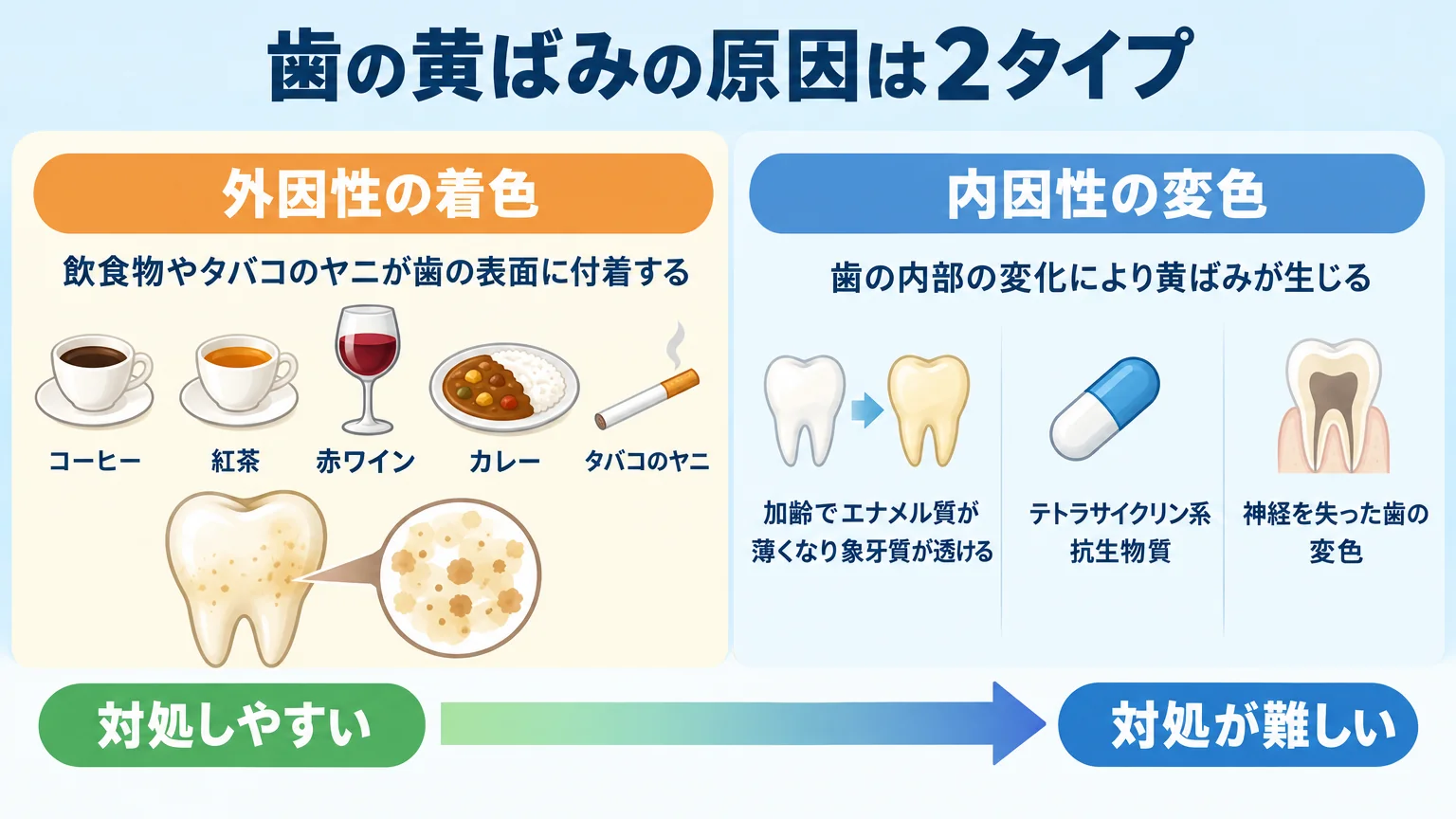 歯の黄ばみの原因を2タイプに分けた図解。左側『外因性の着色』＝コーヒー・紅茶・赤ワイン・カレー・タバコのヤニが歯の表面に付着するイラスト。右側『内因性の変色』＝加齢でエナメル質が薄くなり象牙質が透ける／テトラサイクリン系抗生物質／神経を失った歯の変色。それぞれ対処しやすさの違いを矢印で示す